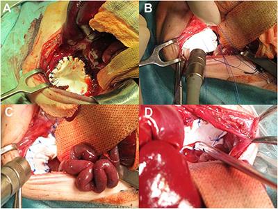 Recurrence of Congenital Diaphragmatic Hernia: Risk Factors, Management, and Future Perspectives